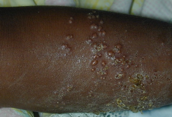 herpes genital picture symptom simplex virus pic photo 