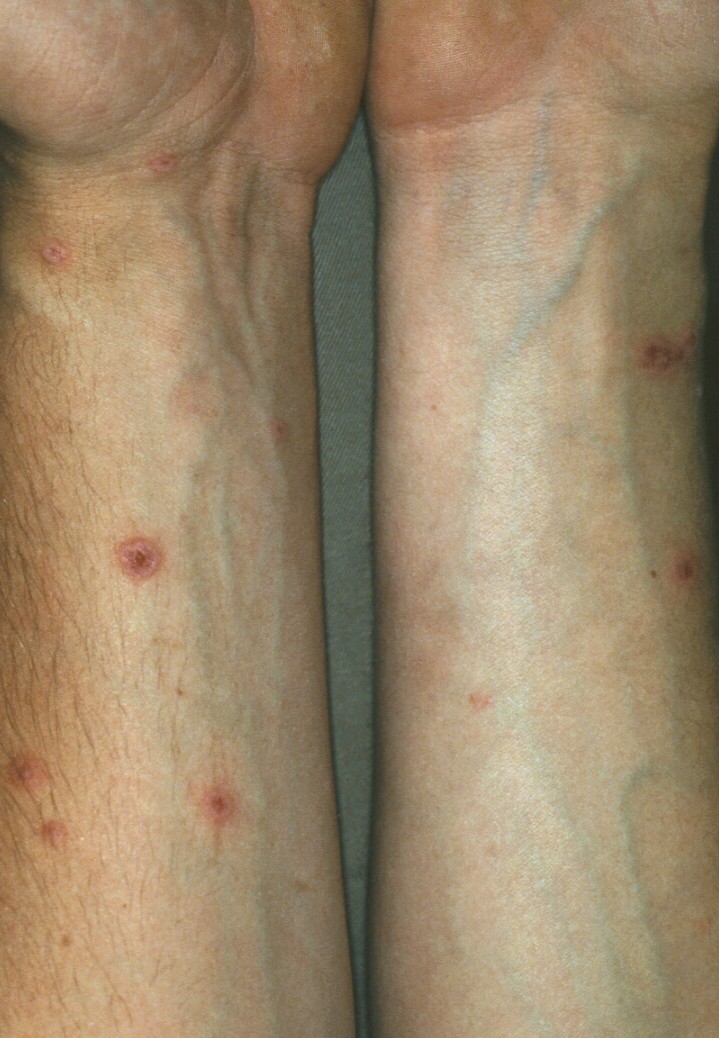 herpes genital picture symptom simplex virus pic photo 