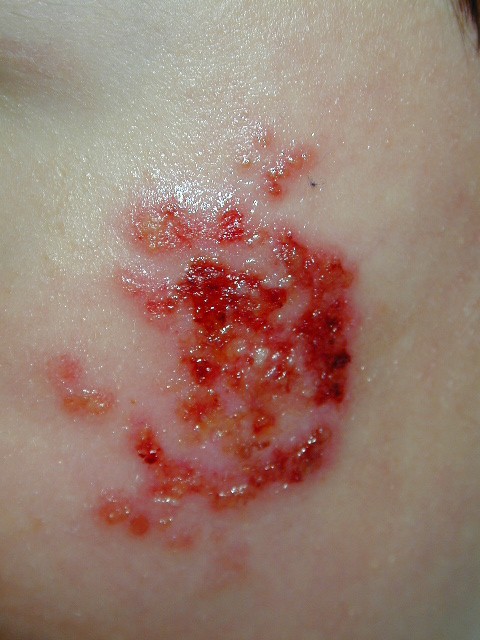 herpes genital picture symptom simplex virus pic photo 