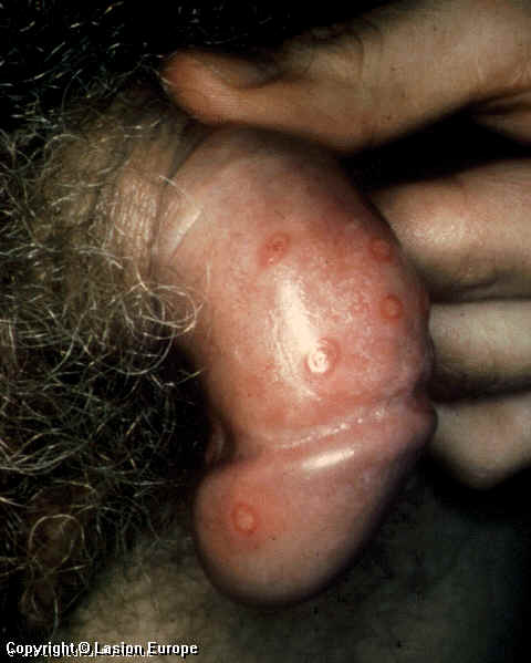 herpes genital picture symptom simplex virus pic photo 